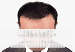 Saç Ekimi Uygulamasından Sonra Saç Ekimi Uygulamasından Sonra